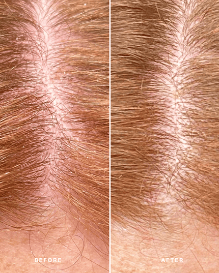 Alpha-H Healthy Scalp Exfoliating Treatment 100ml