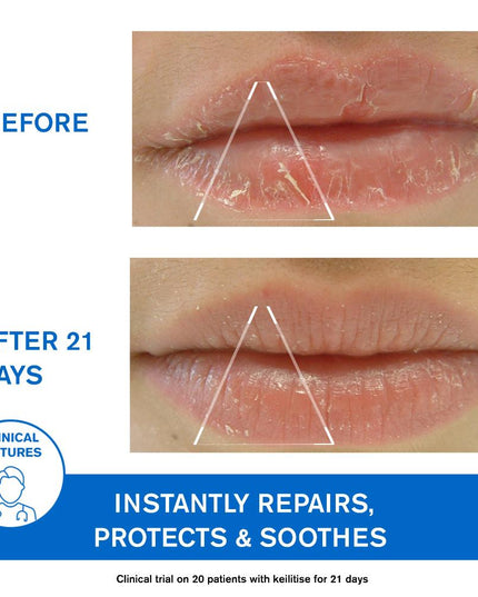 Uriage D.S. Regulating Emulsion, Irritation, Redness, Scales 40ml